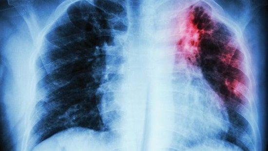 Regenerative medicine can be a boon for those with Drug-Resistant Tuberculosis (Photo by Twitter/sciam)