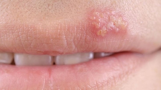 Cold sores: Why sharing a kiss could spread more than love (Photo for representation purpose)